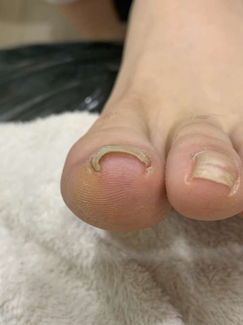 巻き爪矯正前