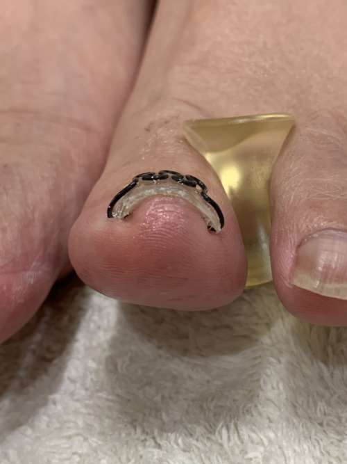 左の巻き爪矯正後