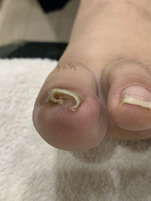 巻き爪