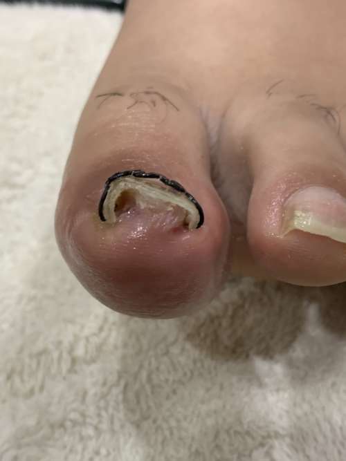 巻き爪矯正