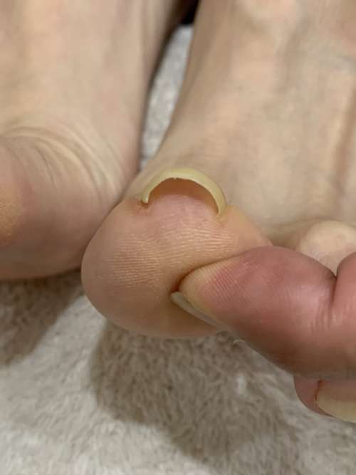 右の巻き爪