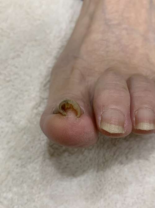 巻き爪