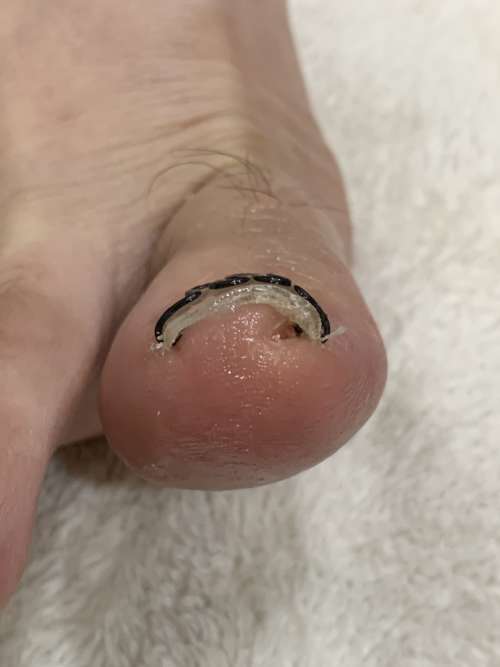 右の巻き爪矯正
