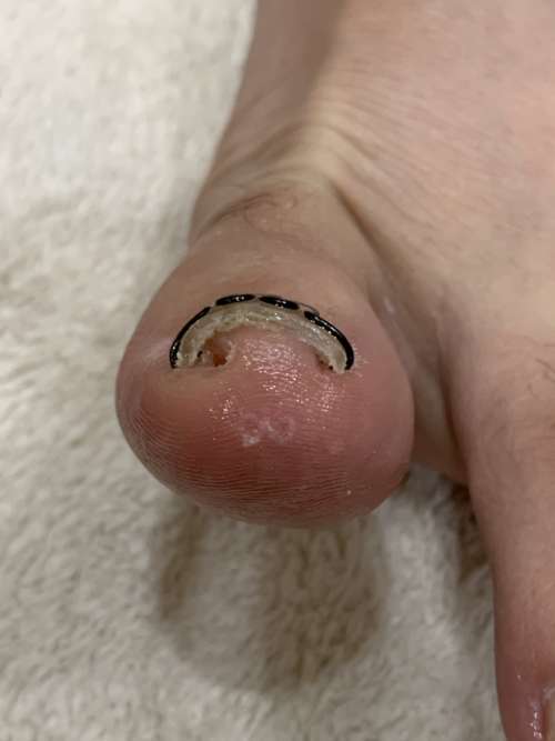 左の巻き爪矯正
