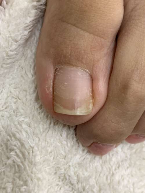 巻き爪矯正前