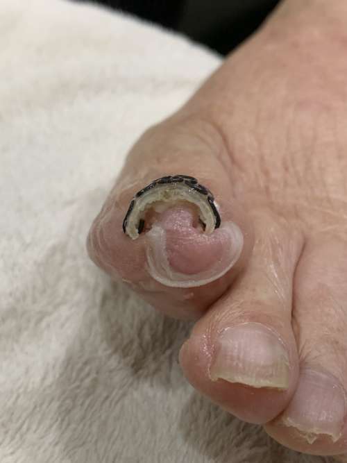 巻き爪矯正