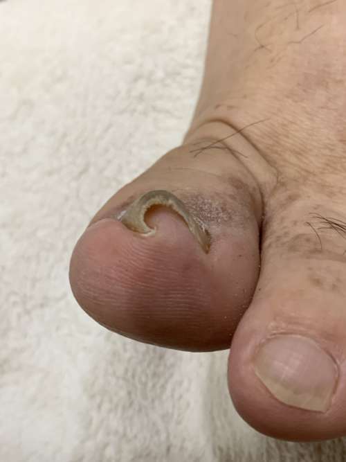 巻き爪