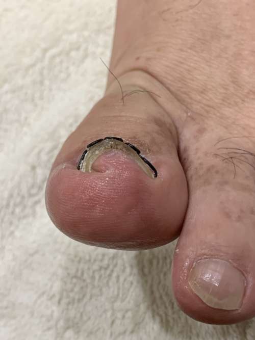 巻き爪矯正