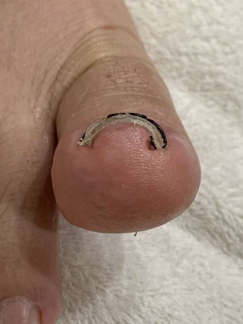 巻き爪矯正後