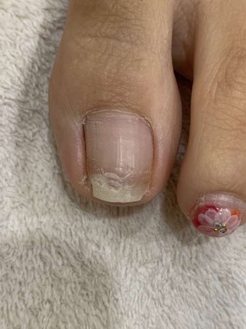 左の巻き爪