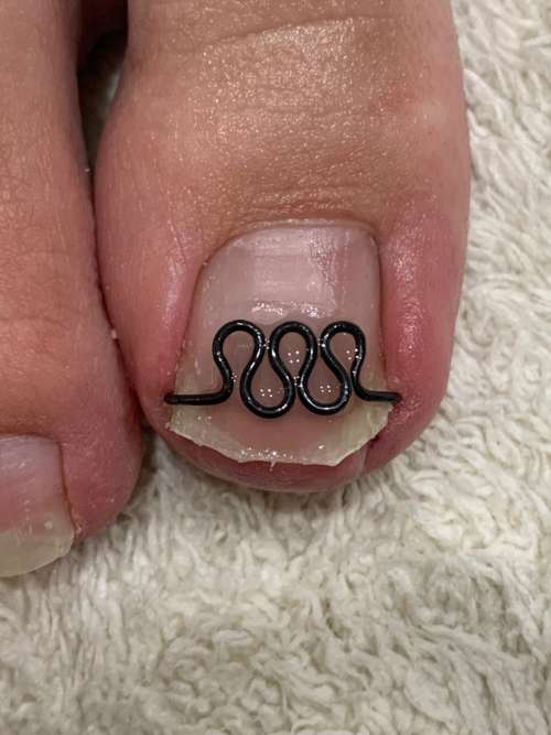 巻き爪矯正後