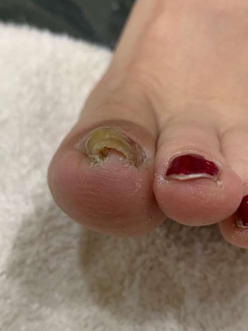 巻き爪