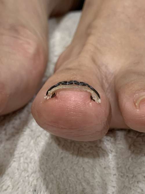 左の巻き爪矯正