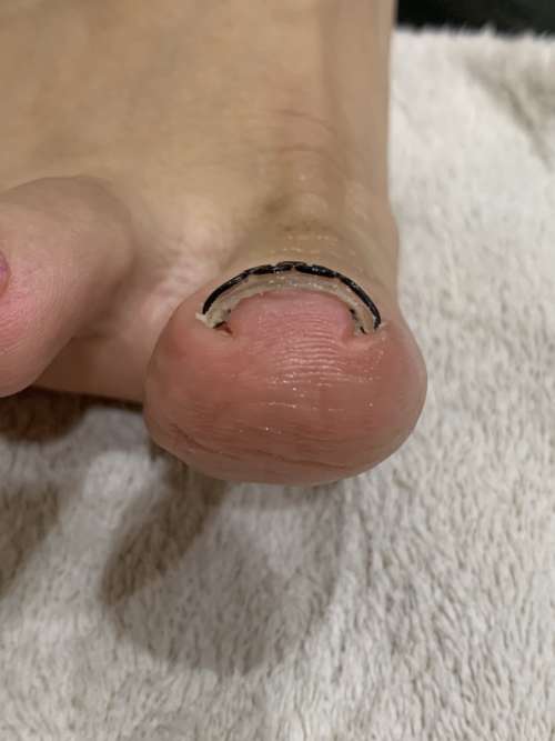 巻き爪矯正