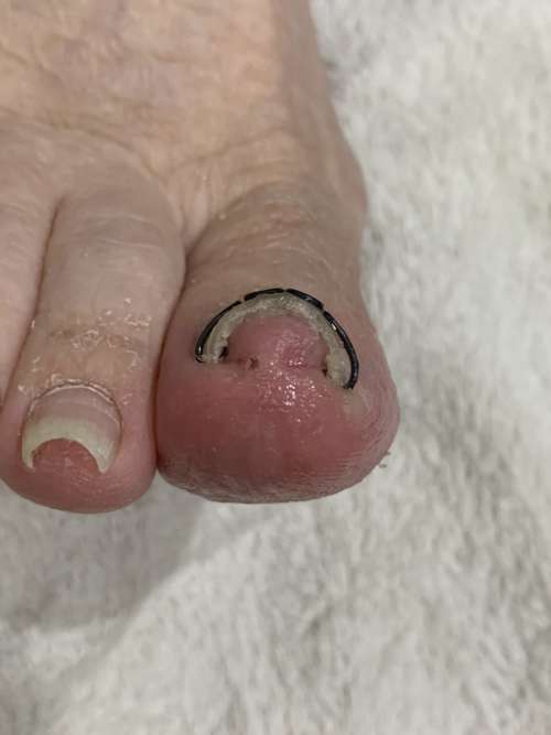 左の巻き爪矯正
