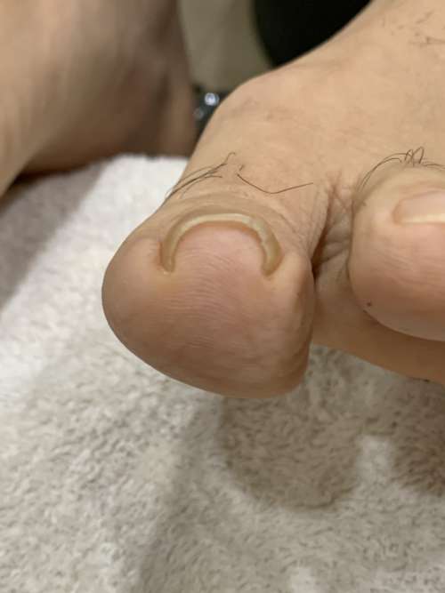 左の巻き爪