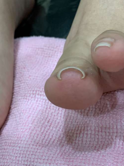 左の巻き爪