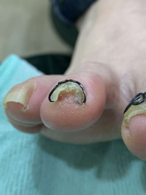 人差し指の巻き爪矯正